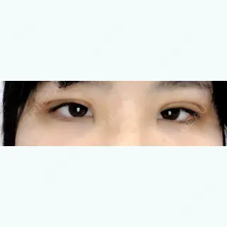 6日目の経過画像（1枚目）