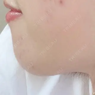 2日目の経過画像（1枚目）