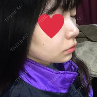 4日目の経過画像（2枚目）