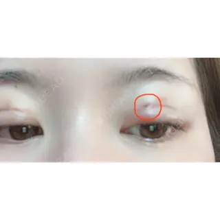 2日目の経過画像（3枚目）