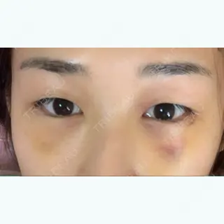 5日目の経過画像（1枚目）