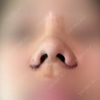 5日目の経過画像（1枚目）