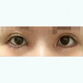 18日目の経過画像（1枚目）