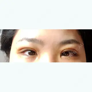 8日目の経過画像（1枚目）