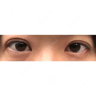 0日目の経過画像（1枚目）