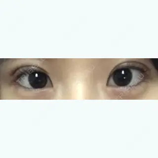 1日目の経過画像（1枚目）