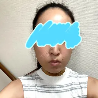 4日目の経過画像（1枚目）