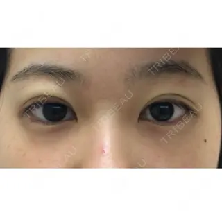 0日目の経過画像（1枚目）