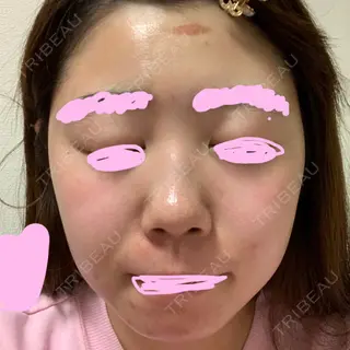 93日目の経過画像（1枚目）
