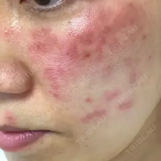0日目の経過画像（2枚目）