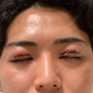 1日目の経過画像（2枚目）