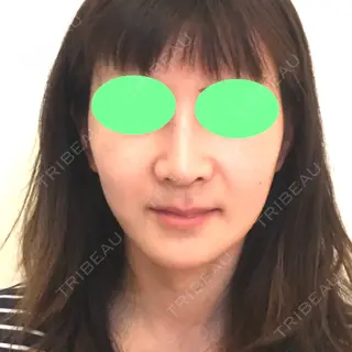74日目の経過画像（1枚目）