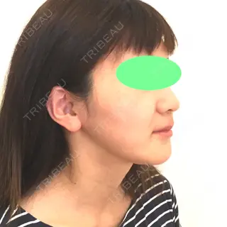 74日目の経過画像（2枚目）