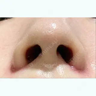 20日目の経過画像（2枚目）