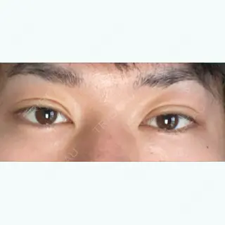 3日目の経過画像（1枚目）