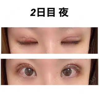 2日目の経過画像（2枚目）