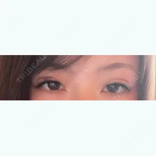 1日目の経過画像（2枚目）
