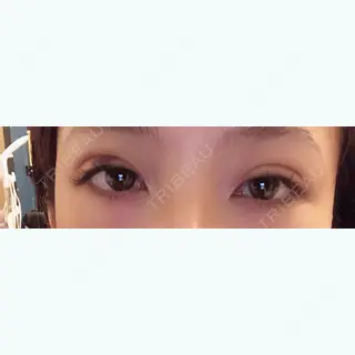 2日目の経過画像（1枚目）