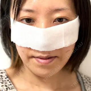 3日目の経過画像（3枚目）