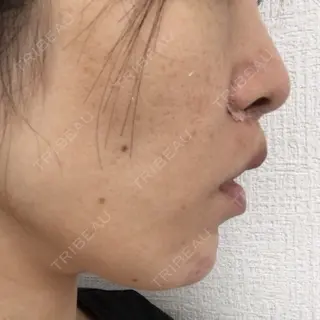 0日目の経過画像（3枚目）