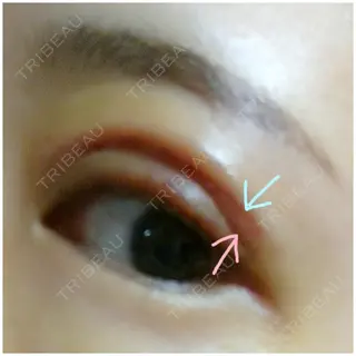 7日目の経過画像（2枚目）