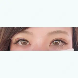 4日目の経過画像（1枚目）