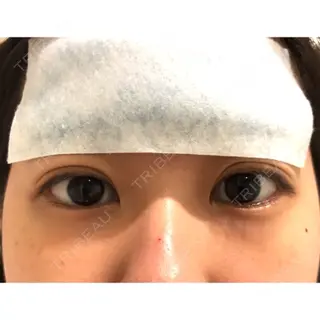 1日目の経過画像（1枚目）