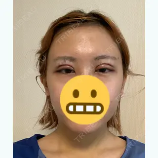 2日目の経過画像（1枚目）