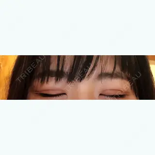 14日目の経過画像（2枚目）