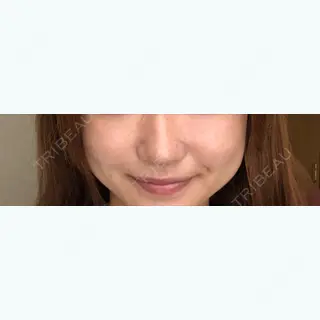 222日目の経過画像（1枚目）