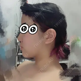 28日目の経過画像（2枚目）