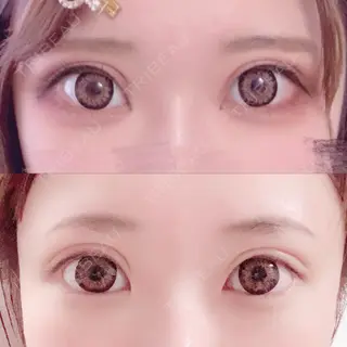 90日目の経過画像（1枚目）