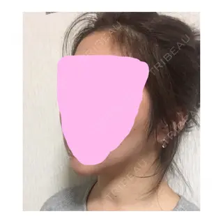 170日目の経過画像（3枚目）