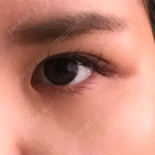 12日目の経過画像（3枚目）