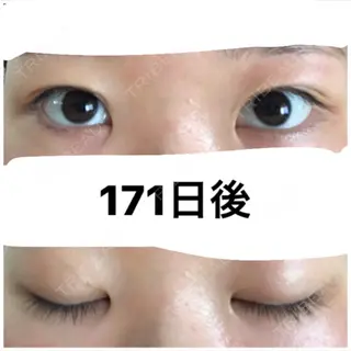171日目の経過画像（1枚目）
