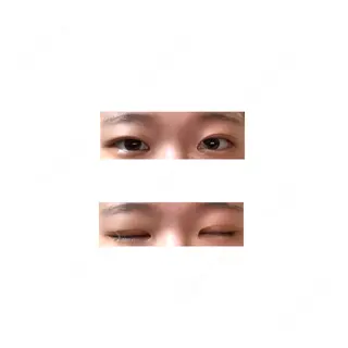 99日目の経過画像（1枚目）