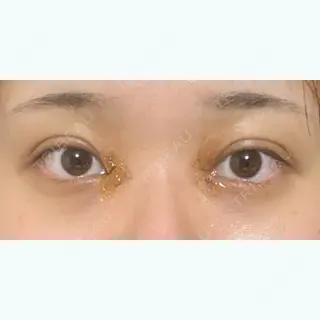 2日目の経過画像（1枚目）