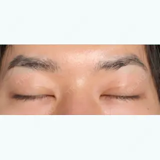 11日目の経過画像（2枚目）