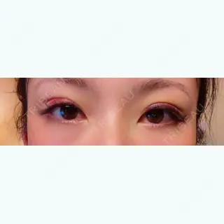 10日目の経過画像（2枚目）