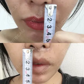 2日目の経過画像（1枚目）