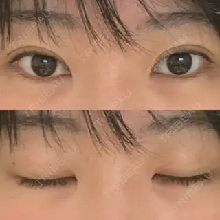 42日目の経過画像（1枚目）