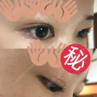 13日目の経過画像（2枚目）