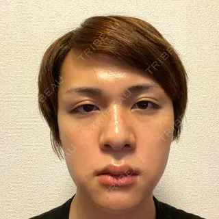 14日目の経過画像（1枚目）