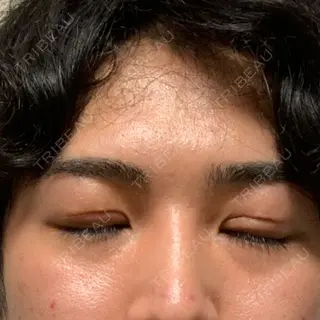 15日目の経過画像（2枚目）