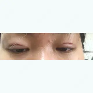1日目の経過画像（1枚目）