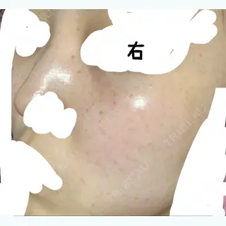 99日目の経過画像（2枚目）