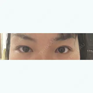 1日目の経過画像（2枚目）