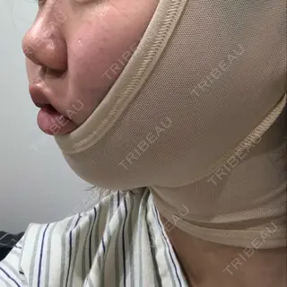 0日目の経過画像（2枚目）
