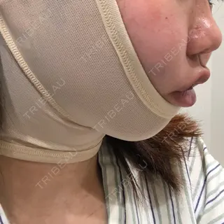 0日目の経過画像（3枚目）