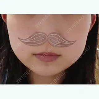 5日目の経過画像（2枚目）